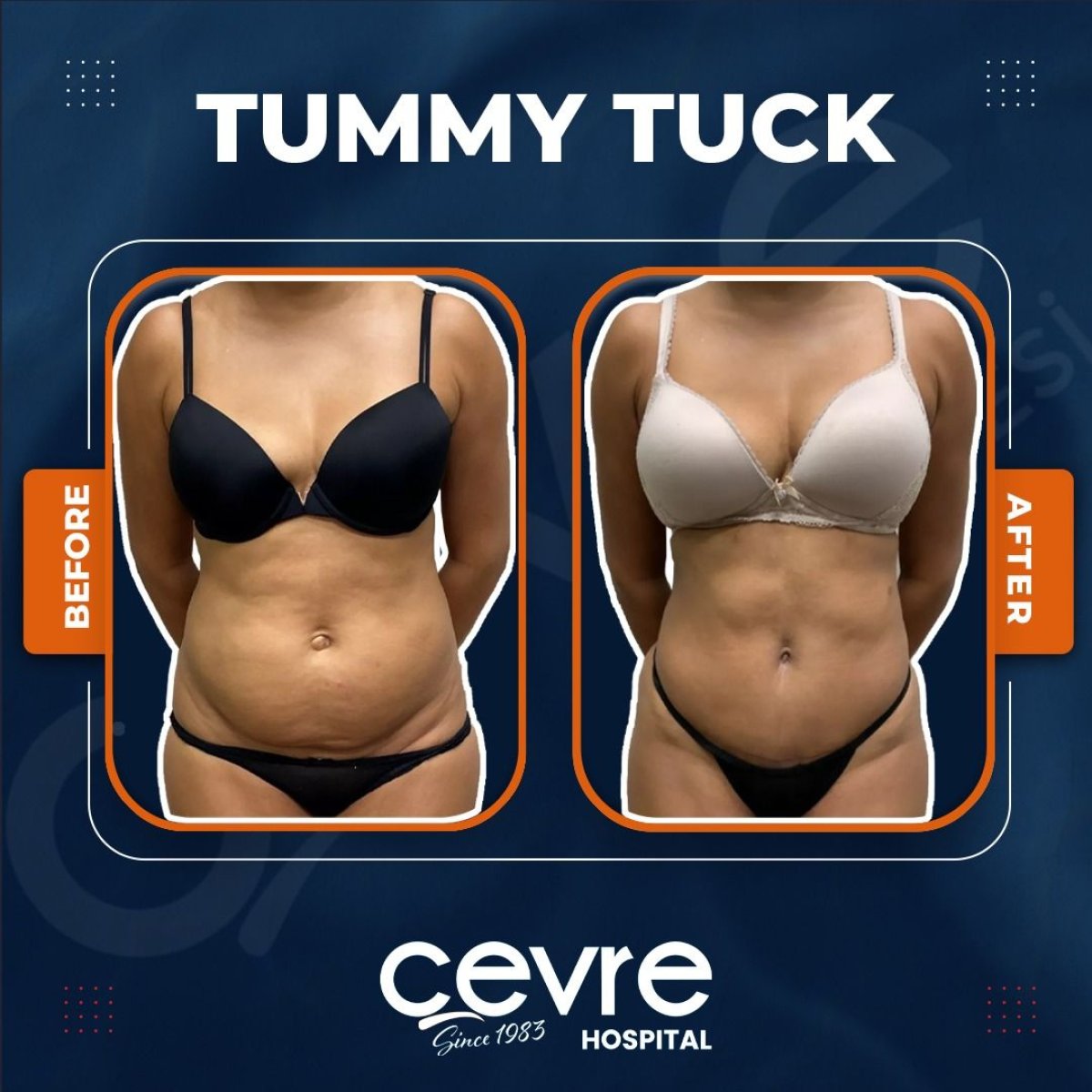 نتائج قبل وبعد عملية تجميل الأم في Adem and Havva Medical Center، بطن مسطح