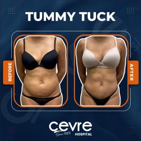 Vorher-nachher-Ergebnis Mommy Makeover bei Adem and Havva Medical Center, flacher Bauch