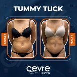 Vorher-nachher-Ergebnis Mommy Makeover bei Adem and Havva Medical Center, flacher Bauch