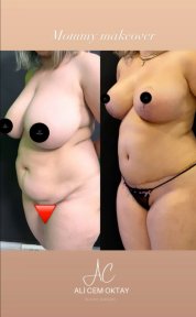 Vorher-nachher-Ergebnis Mommy Makeover bei Adem and Havva Medical Center, Körperkontur