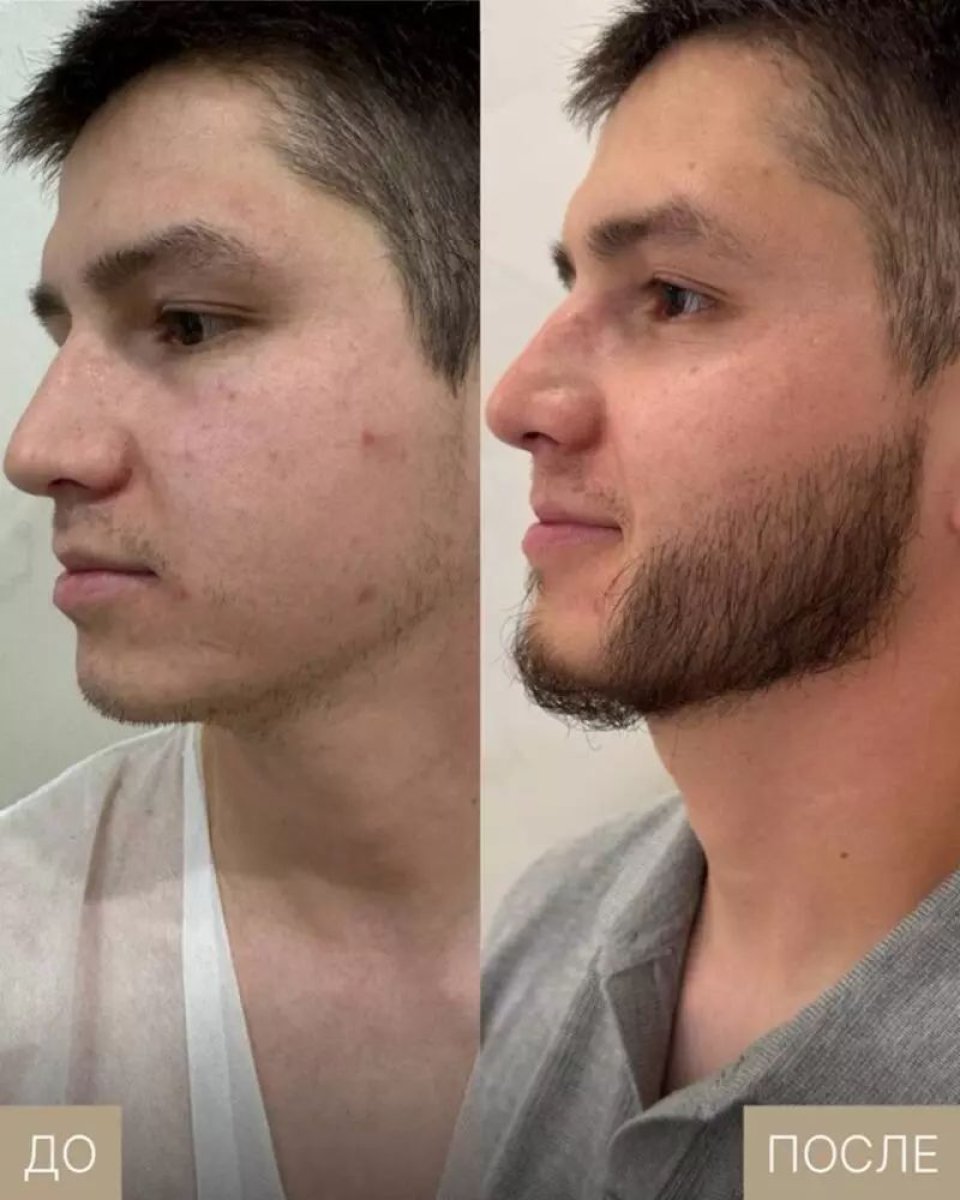 Before and after beard transplant results at Adem and Havva Medical Center, fuller facial hair
