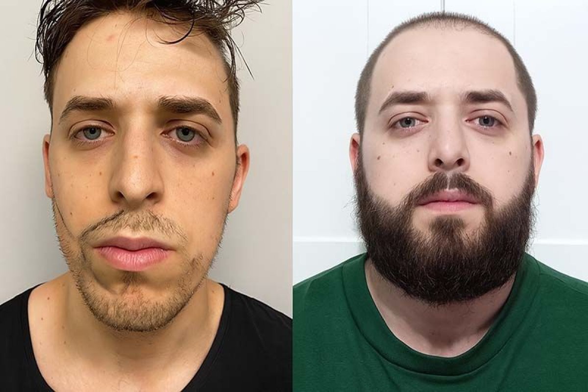 Before and after beard transplant results at Adem and Havva Medical Center, fuller beard achieved
