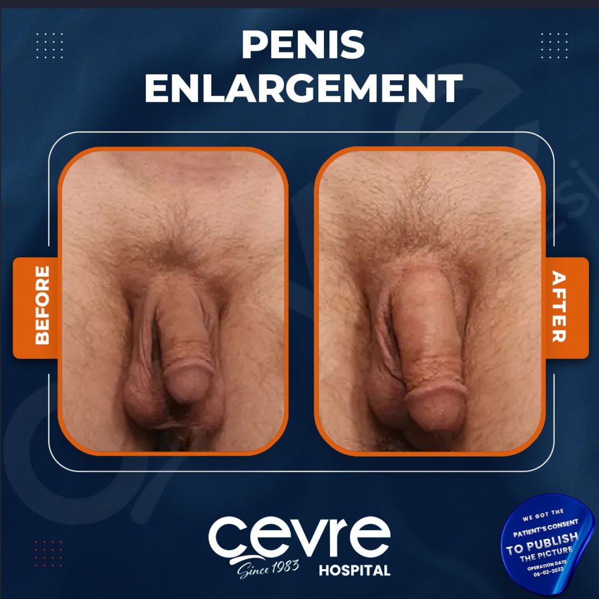 Resultados de aumento de pene antes y después en Cevre Hospital, mejora visible del tamaño