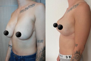 Vorher-nachher-Ergebnis Brustimplantate mit Straffung bei Dr. Safa Manav Clinic, Kontur