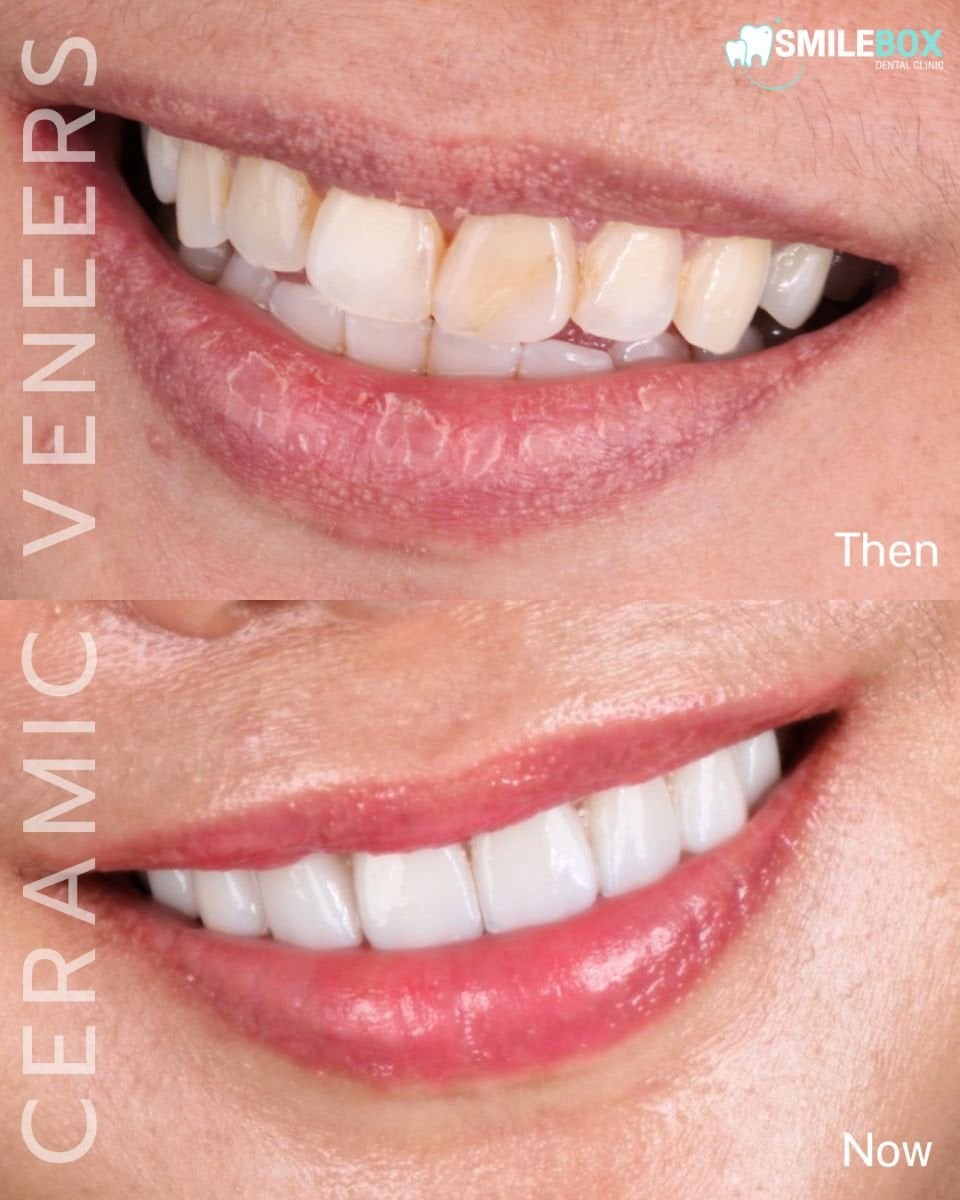 Resultado antes y después de carillas cerámicas en SmileBox Dental Clinic - Thonglor, Sukhumvit
