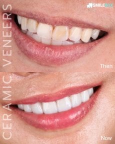 Vorher-nachher-Ergebnis Keramikveneers bei SmileBox Dental Clinic - Thonglor, Sukhumvit
