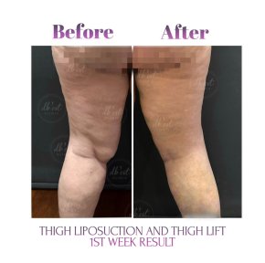 Vorher-nachher-Ergebnis Oberschenkelstraffung und Fettabsaugung bei Db'est Clinic – schlankeres Bein