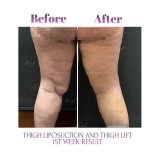 Vorher-nachher-Ergebnis Oberschenkelstraffung und Fettabsaugung bei Db'est Clinic – schlankeres Bein