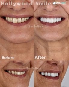 Vorher-nachher-Ergebnisse Veneers bei SmileBox Dental Clinic - Thonglor, Sukhumvit Branch
