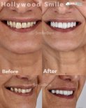 Vorher-nachher-Ergebnisse Veneers bei SmileBox Dental Clinic - Thonglor, Sukhumvit Branch