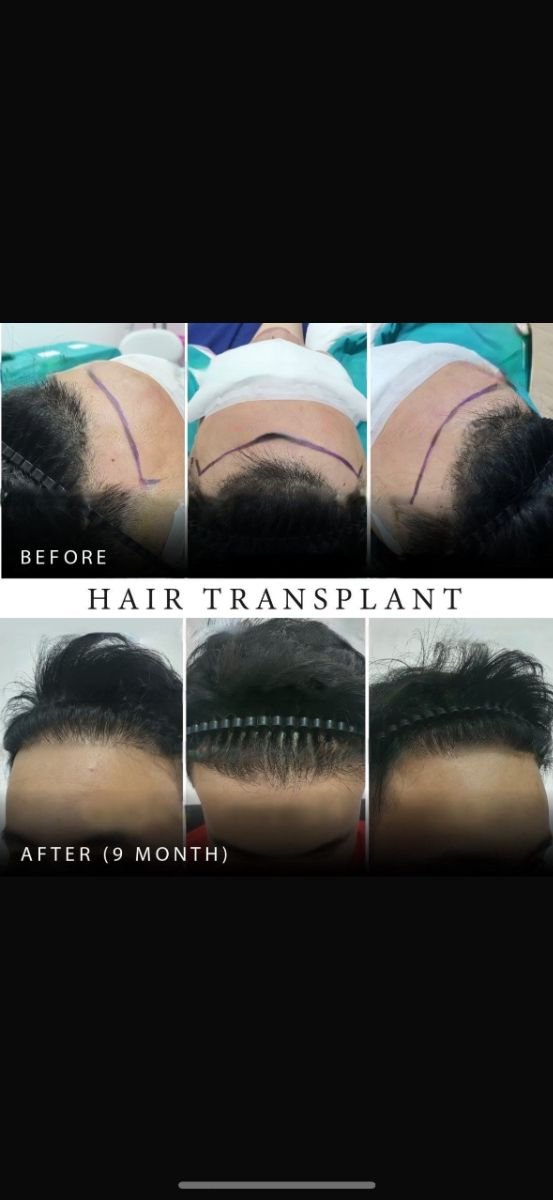 نتائج زراعة الشعر FUE قبل وبعد في Asia Cosmetic Hospital بعد 9 أشهر من الإجراء