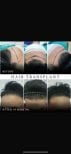 Before and after FUE hair transplant results at Asia Cosmetic Hospital, 9 months post-procedure