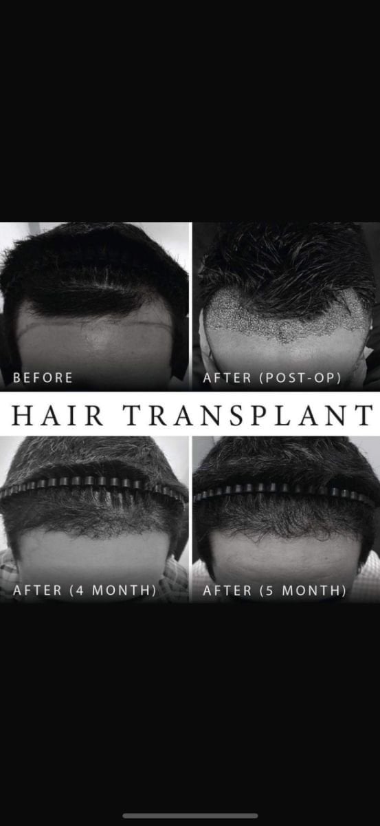 Resultados de trasplante capilar FUE antes y después en Asia Cosmetic Hospital, crecimiento visible