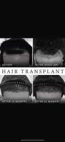FUE hair transplant before and after results at Asia Cosmetic Hospital, visible hair growth progress