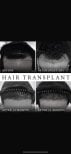FUE hair transplant before and after results at Asia Cosmetic Hospital, visible hair growth progress