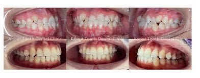 نتائج قبل وبعد تقويم Invisalign في About Tooth Dental Clinic – تحسين انتظام الأسنان