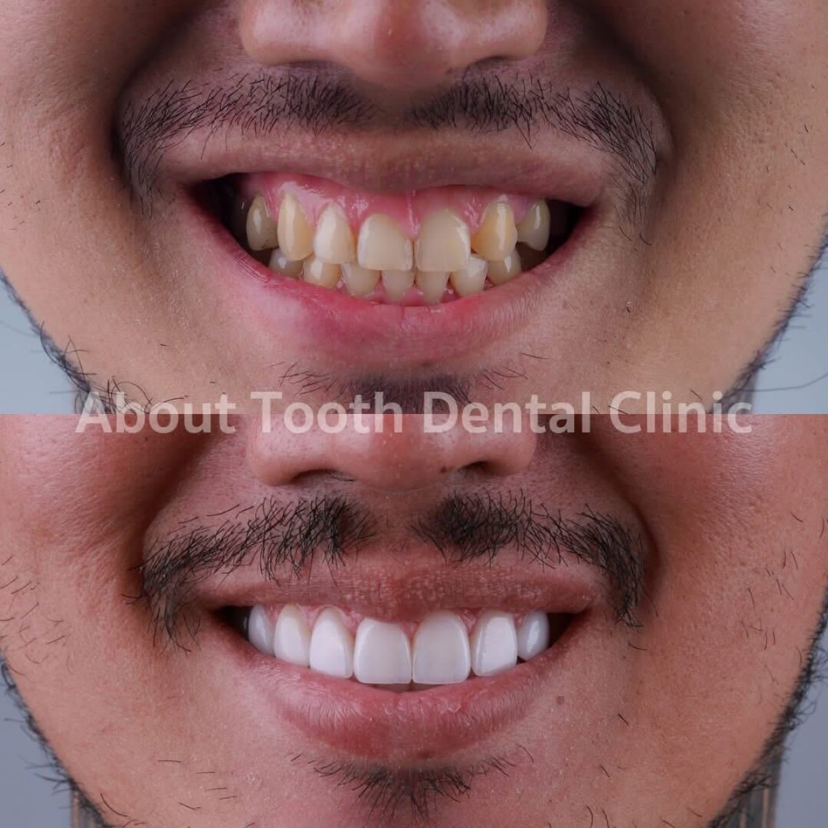 نتائج ابتسامة هوليود قبل وبعد في About Tooth Dental Clinic – تحول ملحوظ للابتسامة