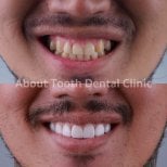 Resultados de Hollywood Smile antes y después en About Tooth Dental Clinic – cambio visible