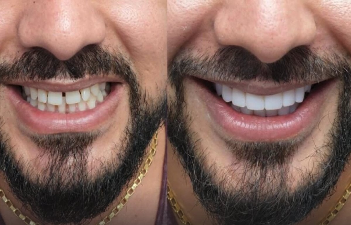 Голливудская улыбка до и после в About Tooth Dental Clinic – преображение улыбки винирами