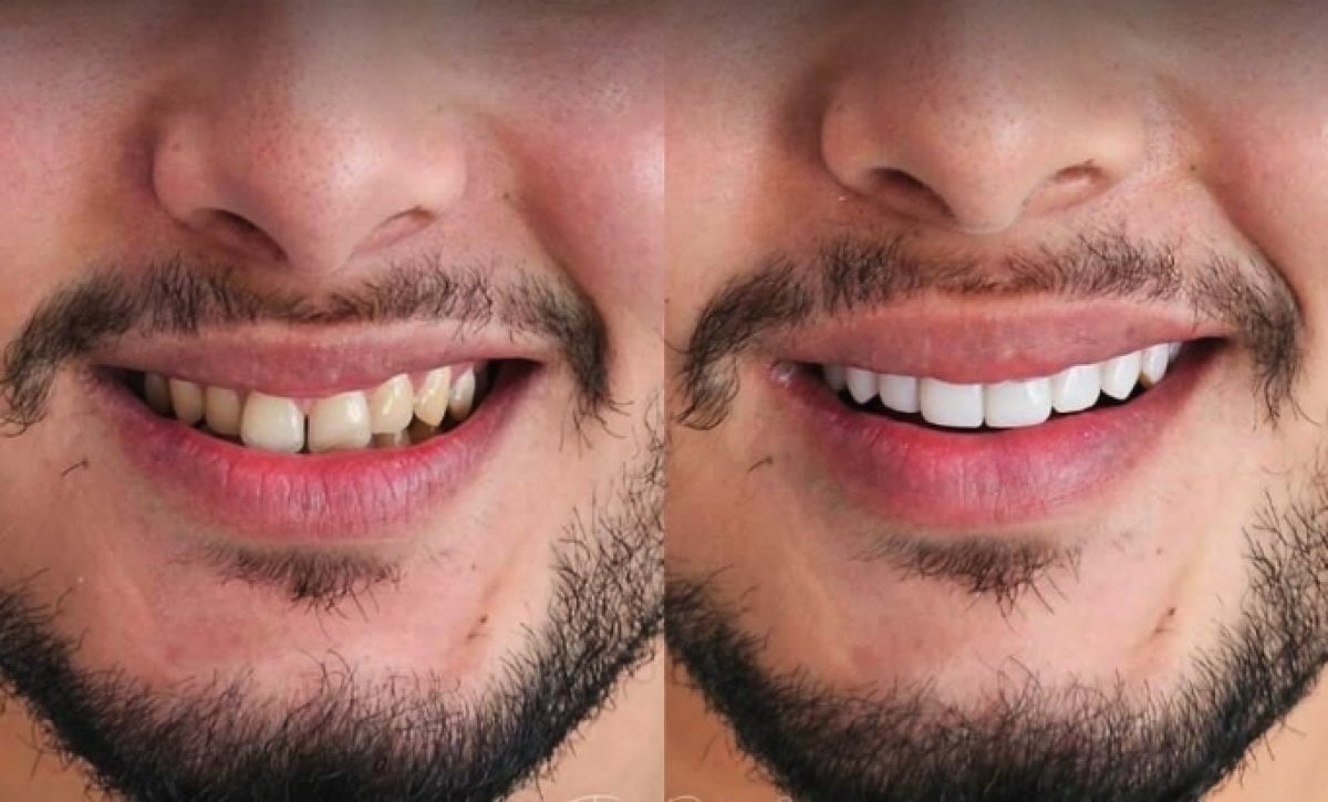 Результаты до и после Hollywood Smile в About Tooth Dental Clinic – преображение улыбки