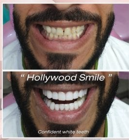 Resultados de Hollywood Smile antes y después en About Tooth Dental Clinic – dientes blancos y alineados