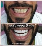 Resultados de Hollywood Smile antes y después en About Tooth Dental Clinic – dientes blancos y alineados