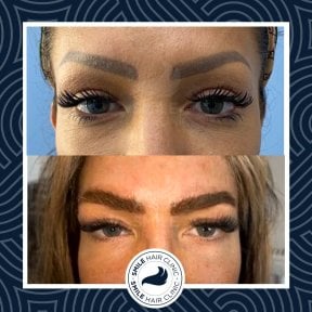 Результати пересадки брів до і після в Smile Hair Clinic | Hair Transplant у Туреччині