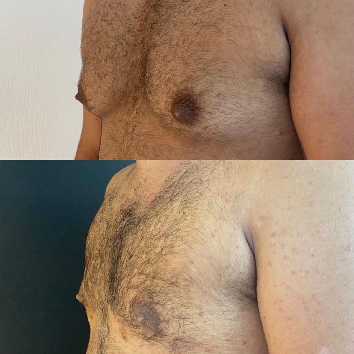 Vorher-nachher-Ergebnis der Gynäkomastie-OP bei Lokman Hekim Istanbul Hospital, Brustkontur