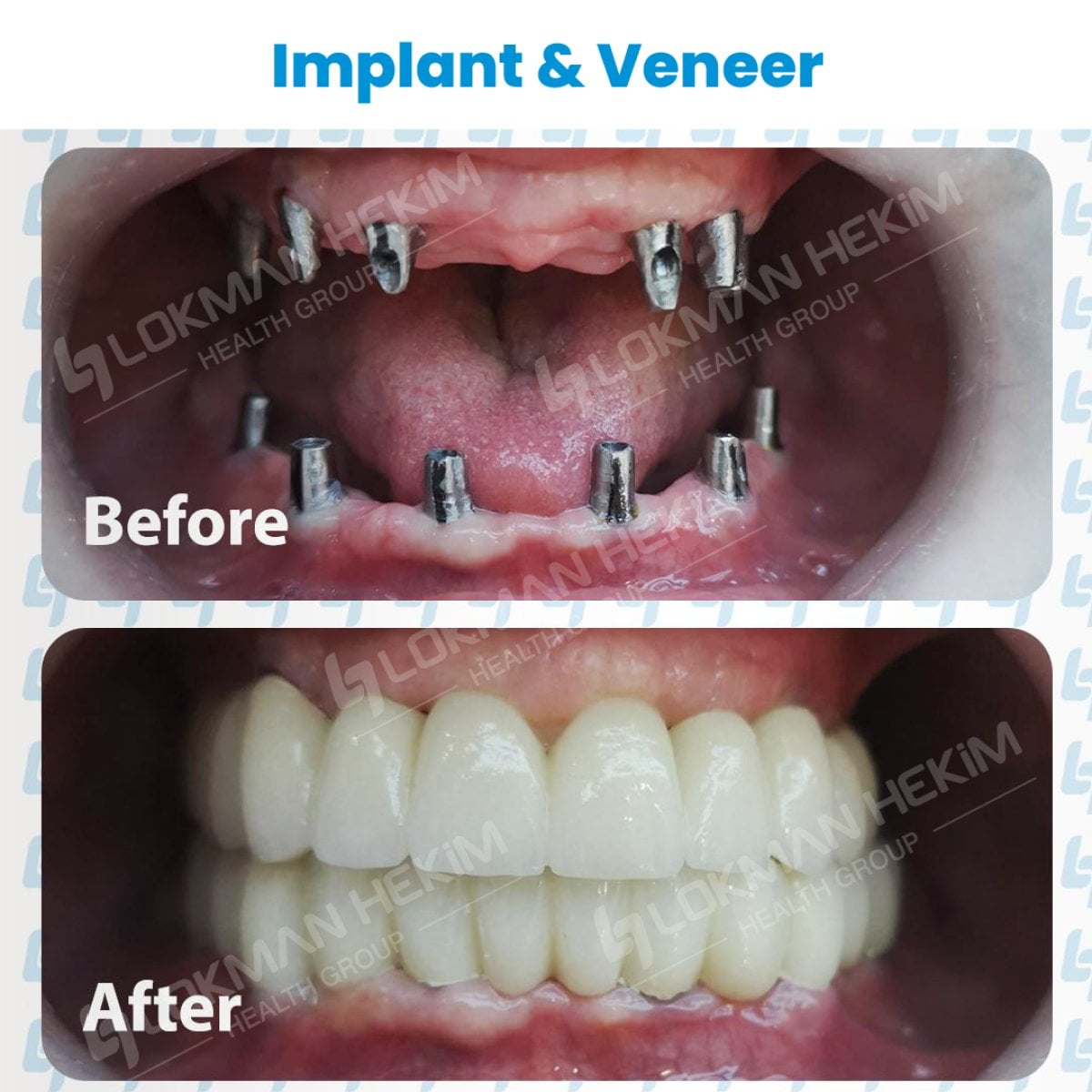 Resultados antes y después de implantes dentales y carillas en Lokman Hekim Estambul