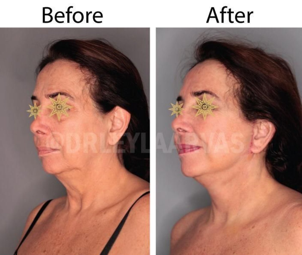 Resultados de minilifting facial antes y después en Quartz Hospital – rejuvenecimiento visible