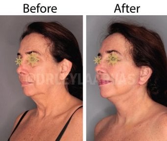 Vorher-nachher-Ergebnis Mini-Facelift bei Quartz Hospital – sichtbare Verjüngung