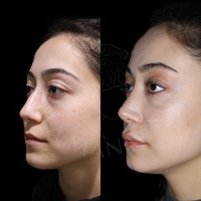 Vorher-nachher-Ergebnisse der Nasenkorrektur in der Dr. Safa Manav Klinik, natürliche Form