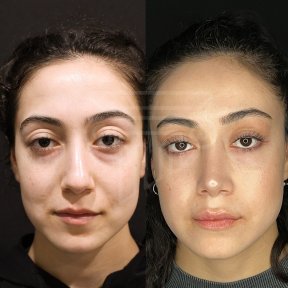 Vorher-nachher-Ergebnis der Nasenkorrektur in der Dr. Safa Manav Clinic, natürliche Form
