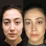 Vorher-nachher-Ergebnis der Nasenkorrektur in der Dr. Safa Manav Clinic, natürliche Form
