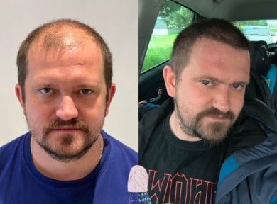 Результаты пересадки волос FUE до и после в Dr. MED – восстановленная линия роста волос