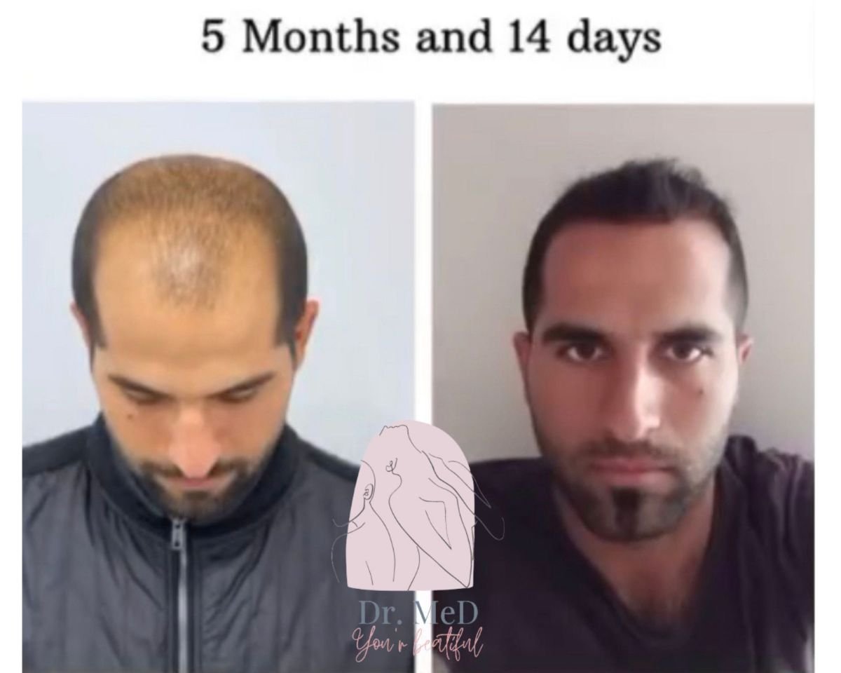 FUE-Haartransplantation bei Dr. MED – vollere Haarlinie nach 5 Monaten