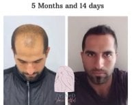 Resultado de trasplante capilar FUE en Dr. MED – línea capilar más densa en 5 meses