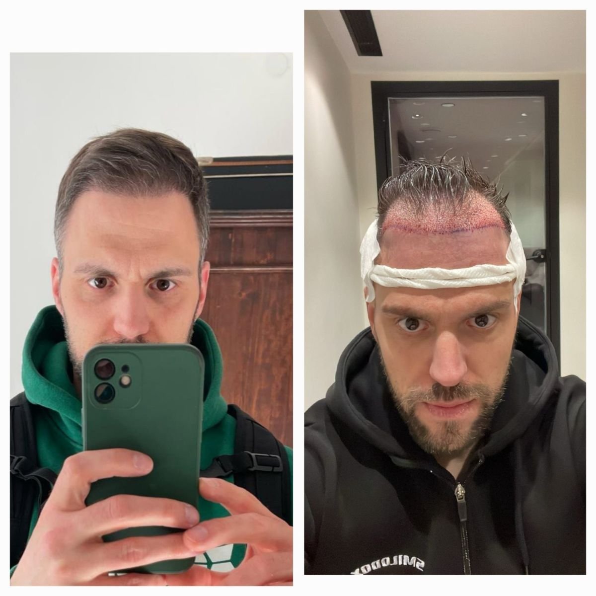 Vorher-nachher-Ergebnis FUE-Haartransplantation bei Dr. MED – verbesserter Haaransatz