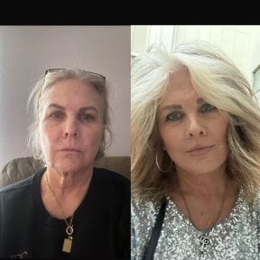 Facelift before and after results at Marroquín & Sandoval Plastic Surgery Clinic, facial rejuvenation