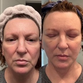 Facelift before and after results at Marroquín & Sandoval Plastic Surgery Clinic, facial rejuvenation