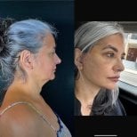 Результати до і після підтяжки обличчя в Marroquín & Sandoval Plastic Surgery Clinic, омолодження