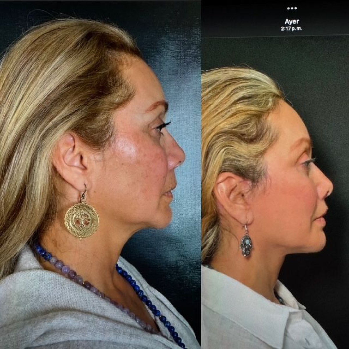 Facelift before and after results at Marroquín & Sandoval Plastic Surgery Clinic, facial rejuvenation