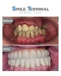 Résultats avant/après implants dentaires chez Smile Terminal Dental Care – sourire restauré