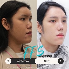 Before and after facelift results at Wansiri Hospital, facial contouring and rejuvenation