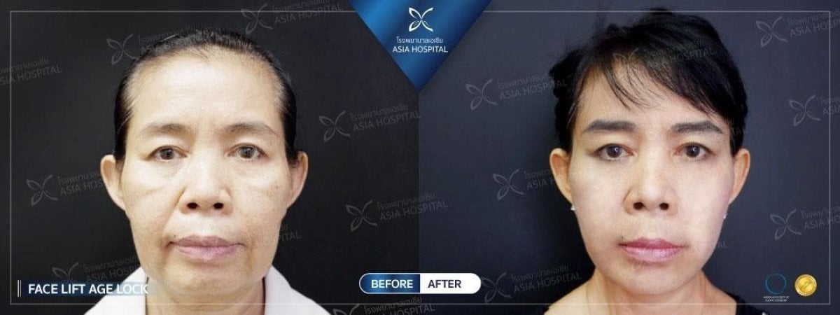 نتائج شد الوجه المصغر قبل وبعد في Asia Cosmetic Hospital، تجديد شباب الوجه