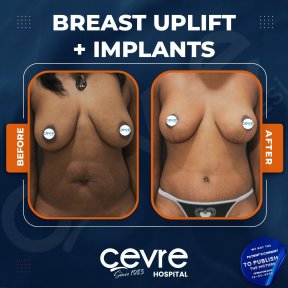 Vorher-nachher-Ergebnis Brustimplantate mit Straffung bei Adem and Havva Medical Center