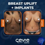 Vorher-nachher-Ergebnis Brustimplantate mit Straffung bei Adem and Havva Medical Center