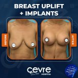 Vorher-nachher-Ergebnis Brustimplantate mit Straffung bei Adem and Havva Medical Center