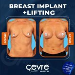 Vorher-nachher-Ergebnis Brustimplantate mit Straffung bei Adem and Havva Medical Center