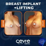 Vorher-nachher-Ergebnis Brustimplantate mit Straffung bei Adem and Havva Medical Center